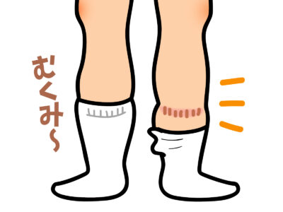 足のむくみから始まる皮膚炎｜うっ滞性皮膚炎の見分け方と治療のポイントのアイキャッチ画像