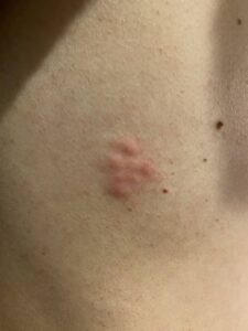 帯状疱疹の症状と治療法｜早期発見で重症化を防ぐ完全ガイドのアイキャッチ画像