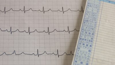 心電図異常を指摘されたら?知っておきたい原因と対処法【検診後の不安を解消】のアイキャッチ画像