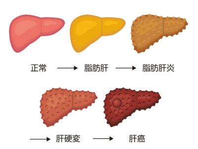 脂肪肝は体重を減らせば改善する？肥満症治療薬「ゼップバウンド」と脂肪肝の関係を解説のアイキャッチ画像