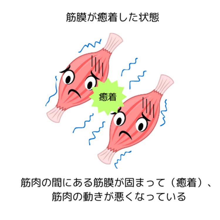 筋膜が癒着した状態