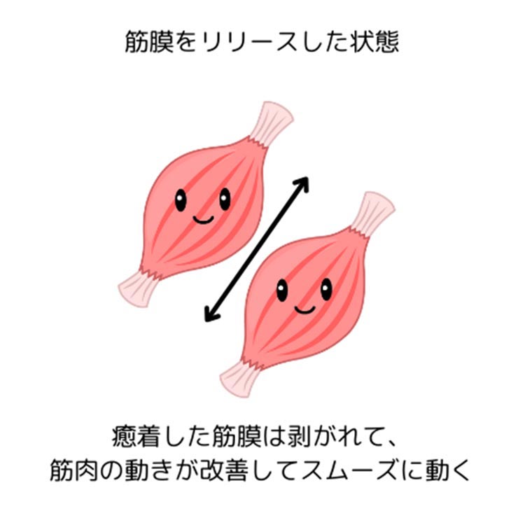 筋膜をリリースした状態