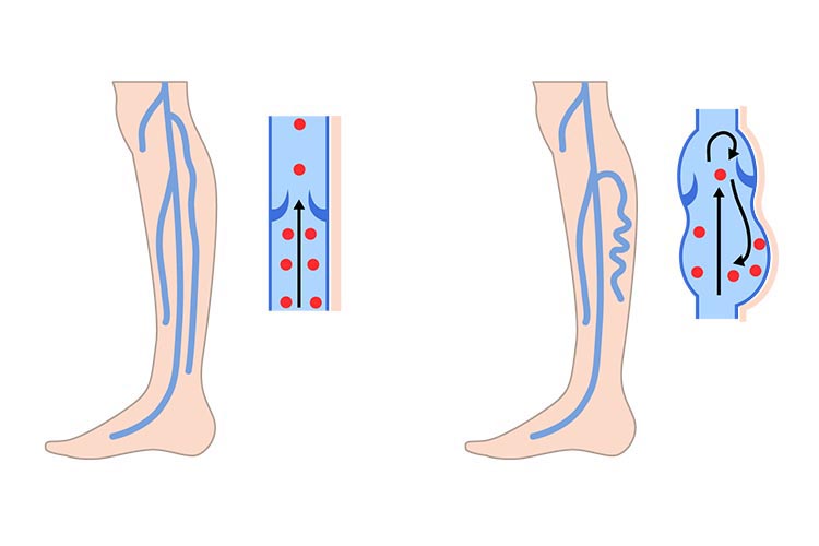 正常な静脈と下肢静脈瘤の比較イラスト